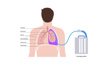 Chest Tube Insertion